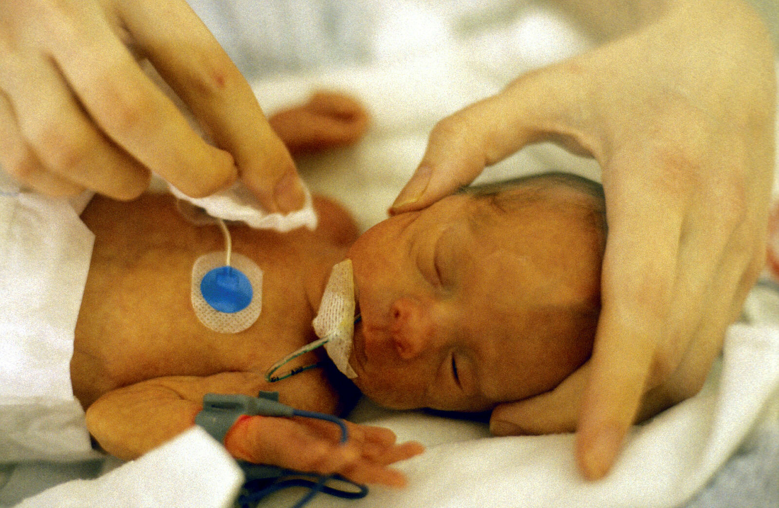 Prematurt barn som stelles i kuvøse