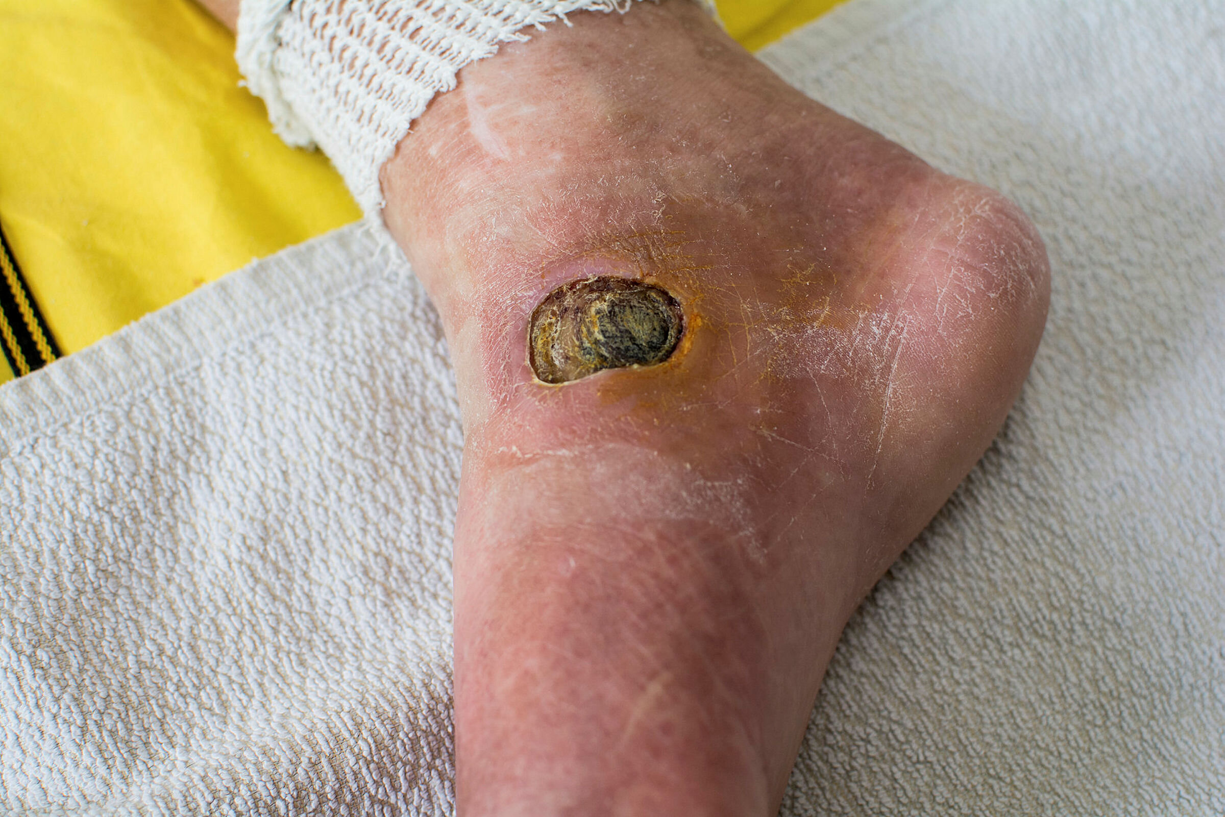 Bildet viser en fot med et stygt diabetessår ved siden av ankelen på innsiden av foten.