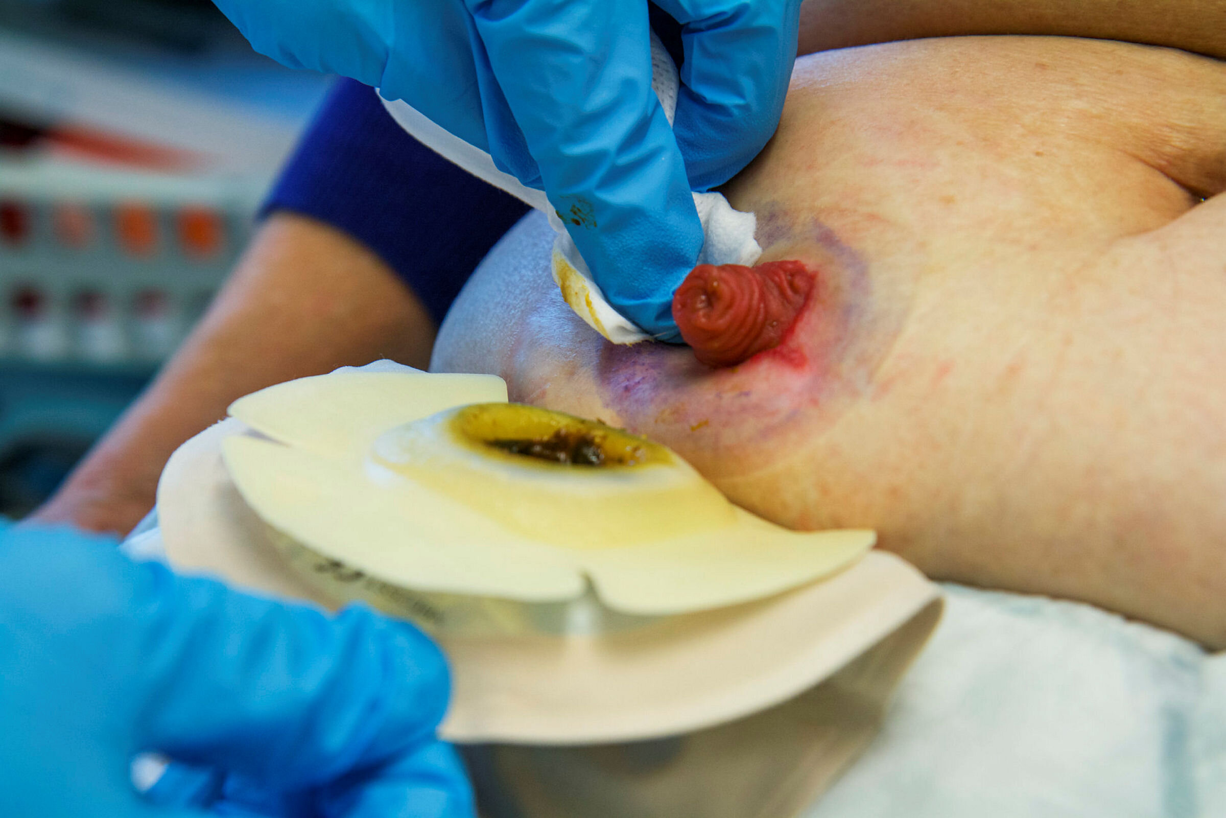 Stomisykepleier Grethe Følstad Lund og Villa Wahl Stranger, Radiumhospitalet