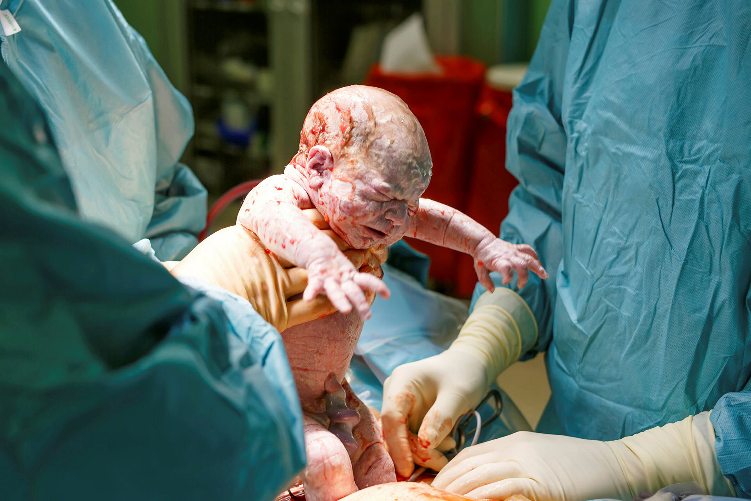 Bildet viser en baby som akkurat er født ved keisersnitt