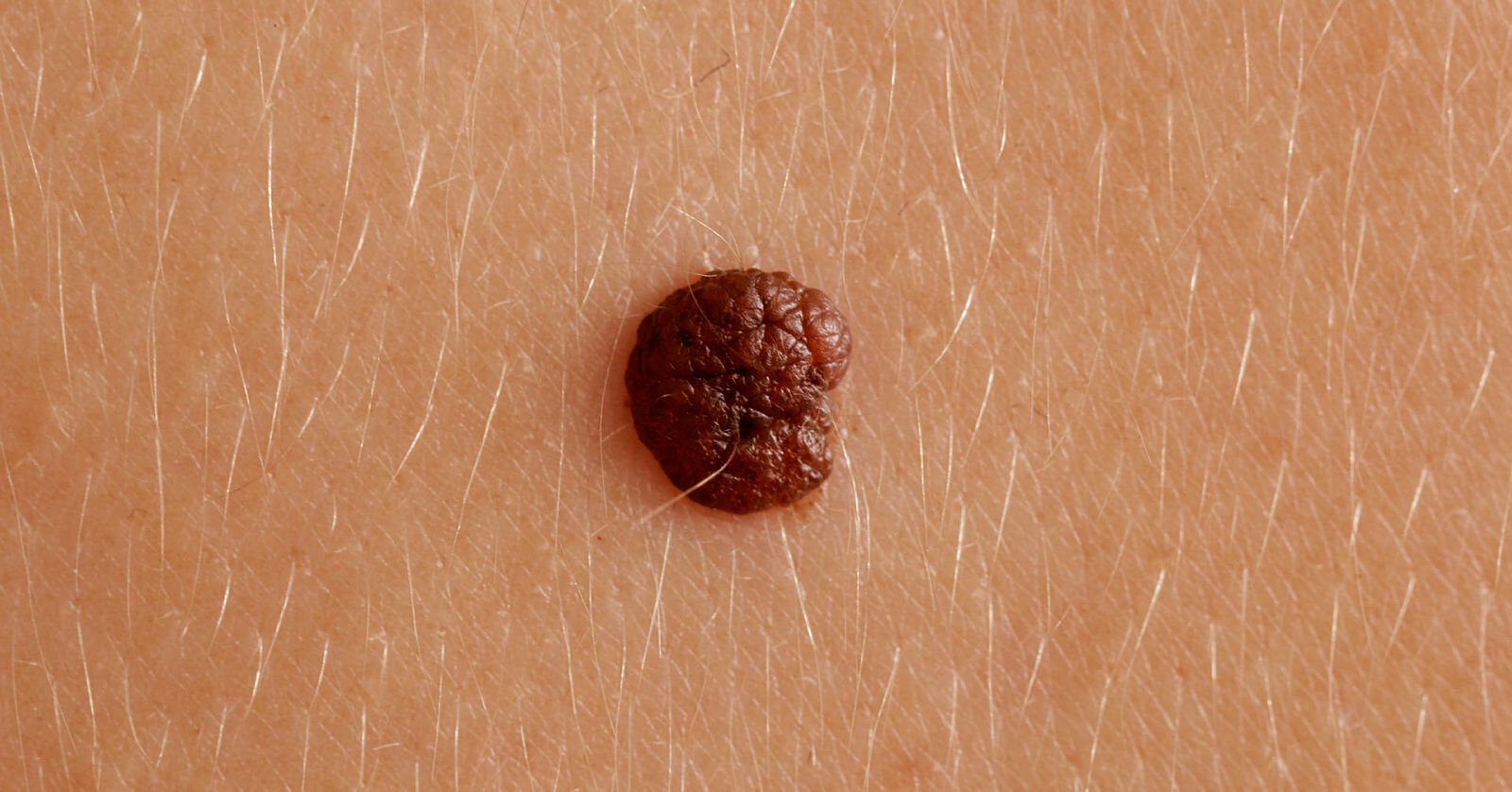 Nærbilde av føflekk
