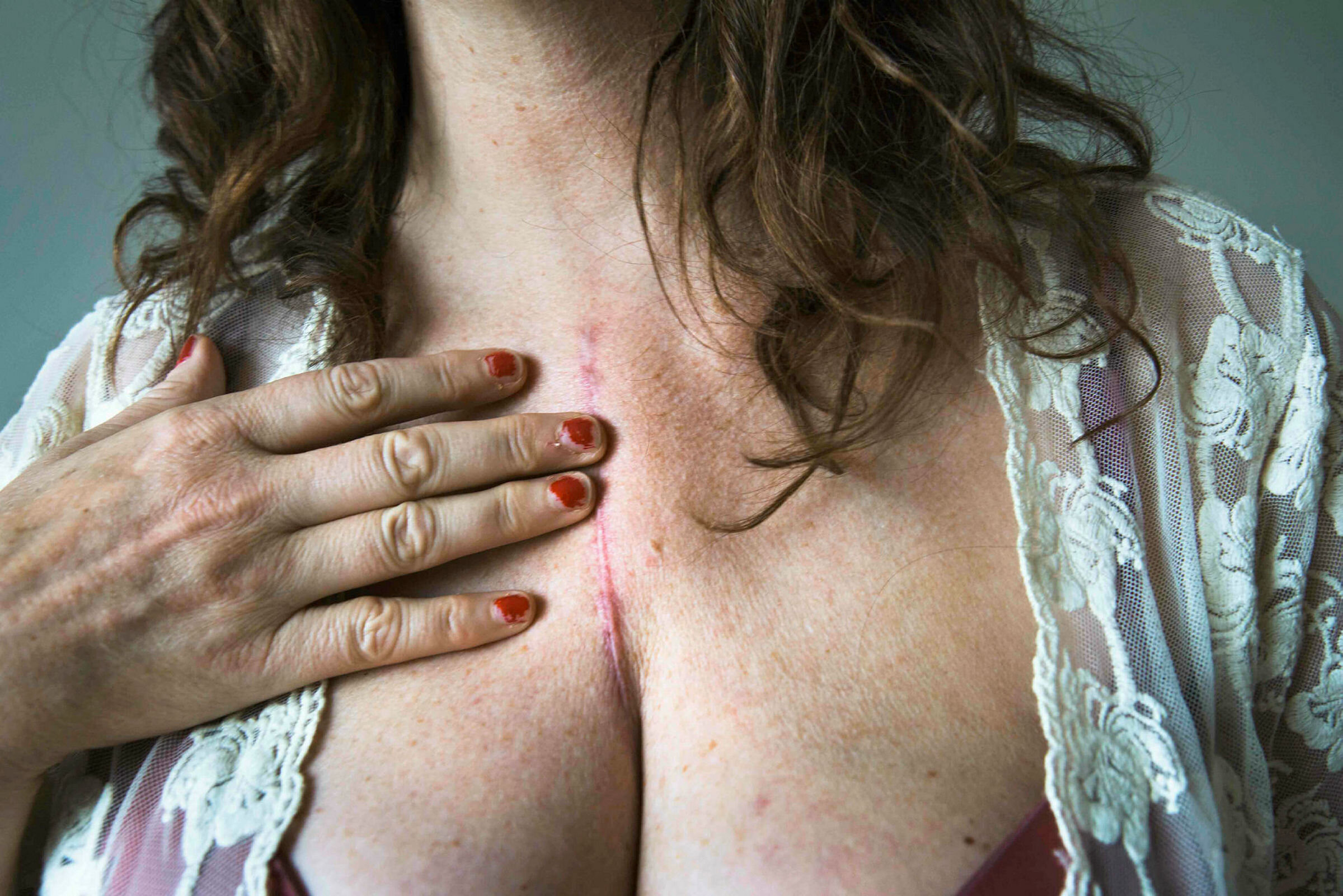 Bildet viser hjerteoperert kvinne