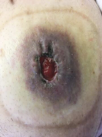 Urin på huden ved urostomi