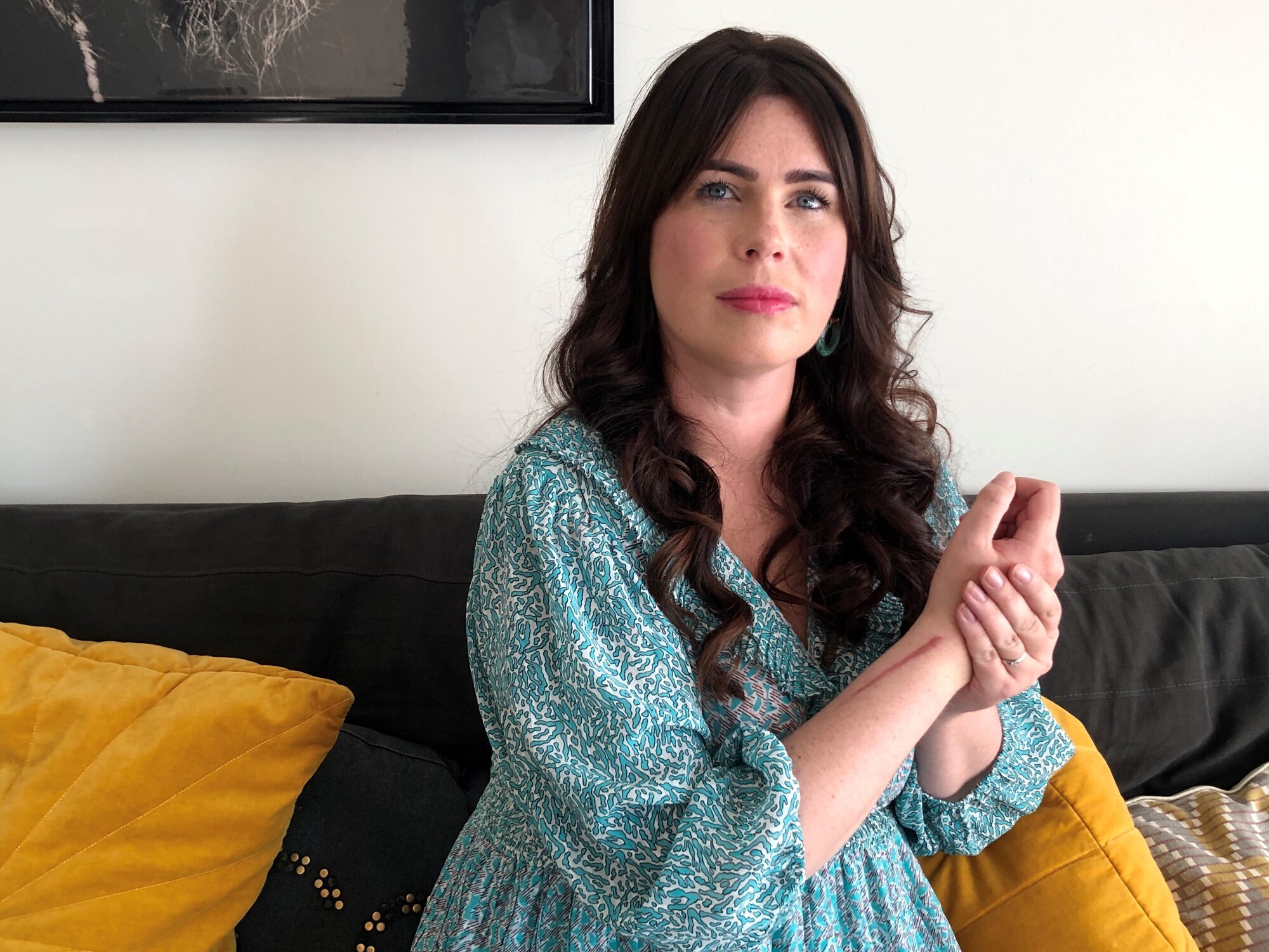 Sykepleier hjemme i sofaen holder venstre hånd på vond høyrearm med arr 