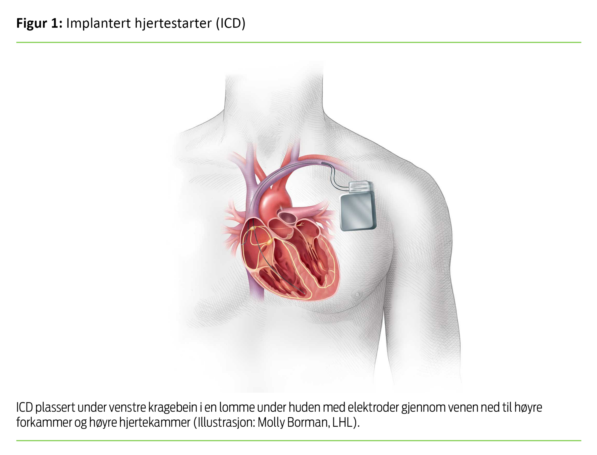 Figur 1. Implantert hjertestarter (ICD)