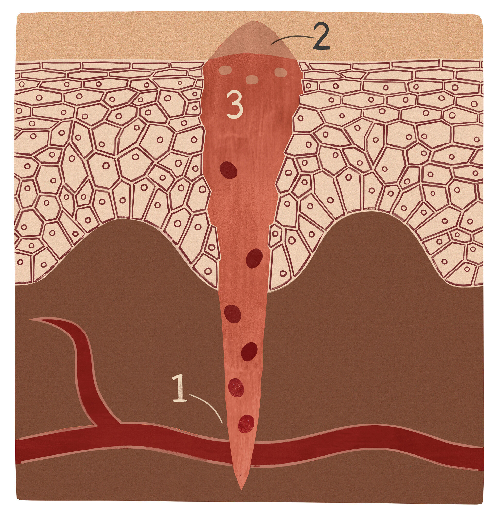 Illustrasjonen viser et sår i koagulasjonsfasen