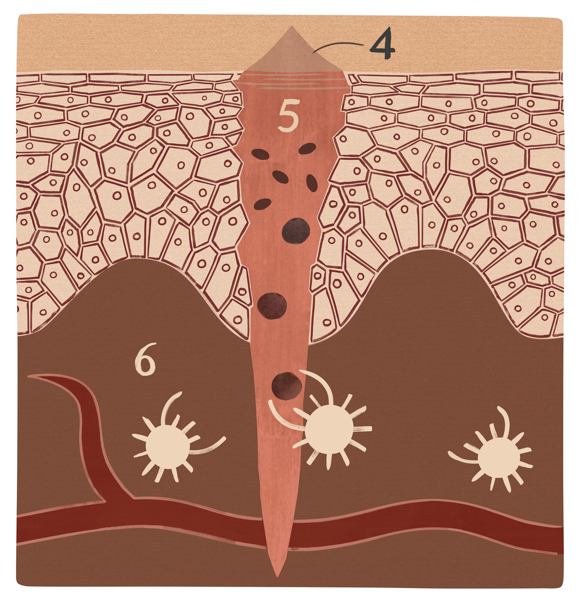 Illustrasjonen viser et sår i inflammasjonsfasen