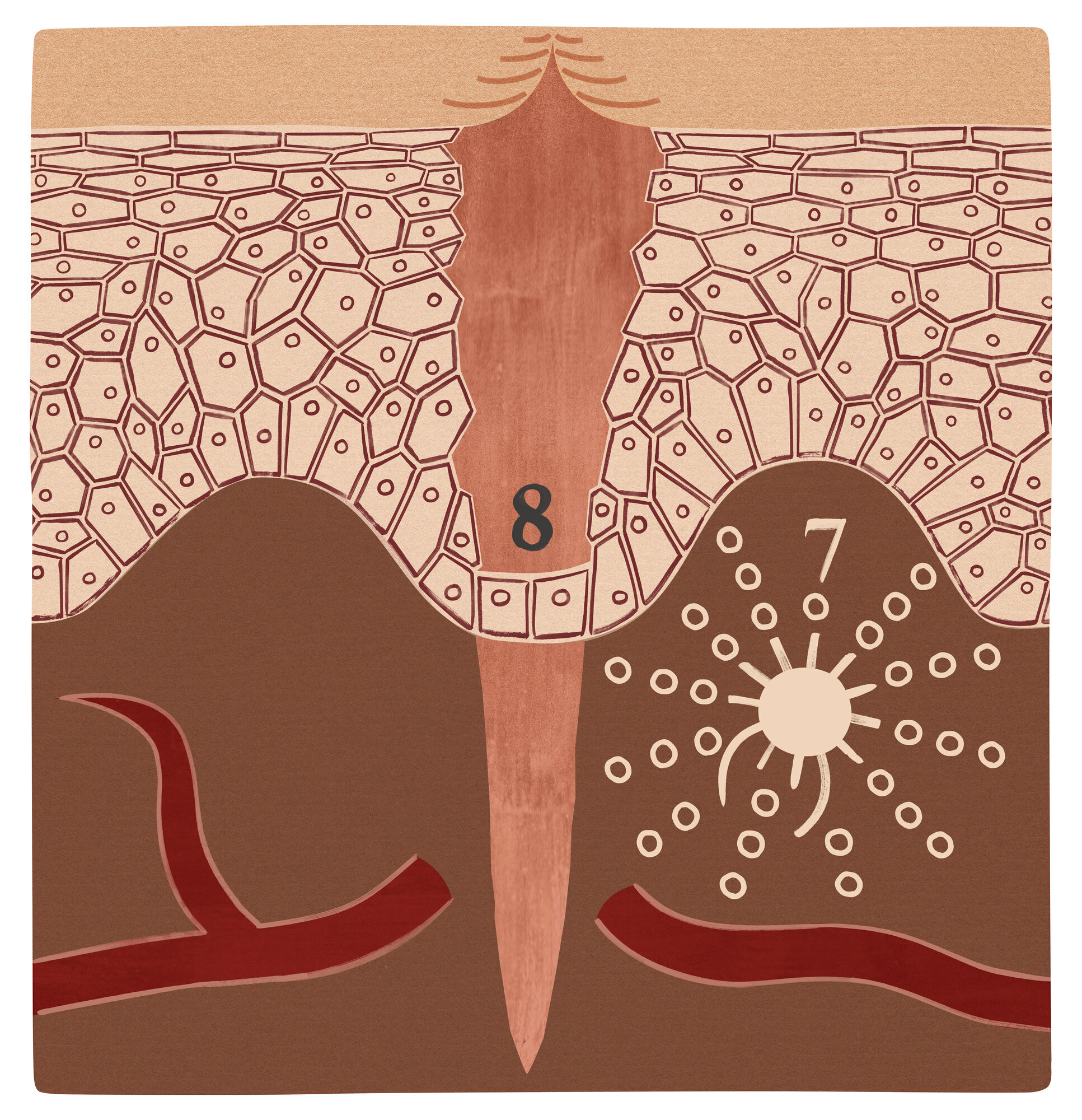 Illustrasjonen viser et sår i inflammasjonsfasen