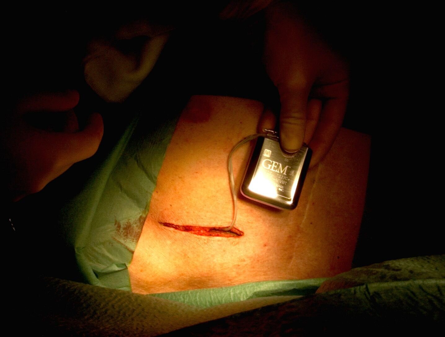 Bildet viser en pasient som får operert inn en hjertestarter