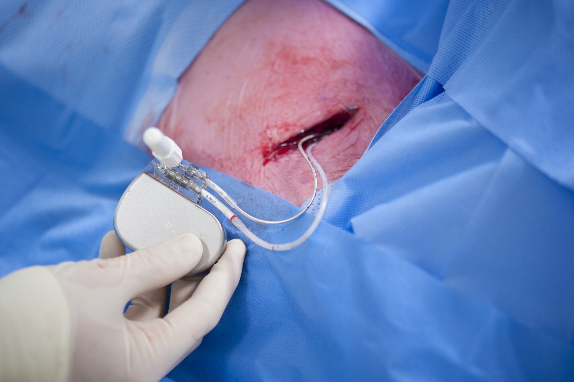 Hjertestarter blir implementert i kroppen.