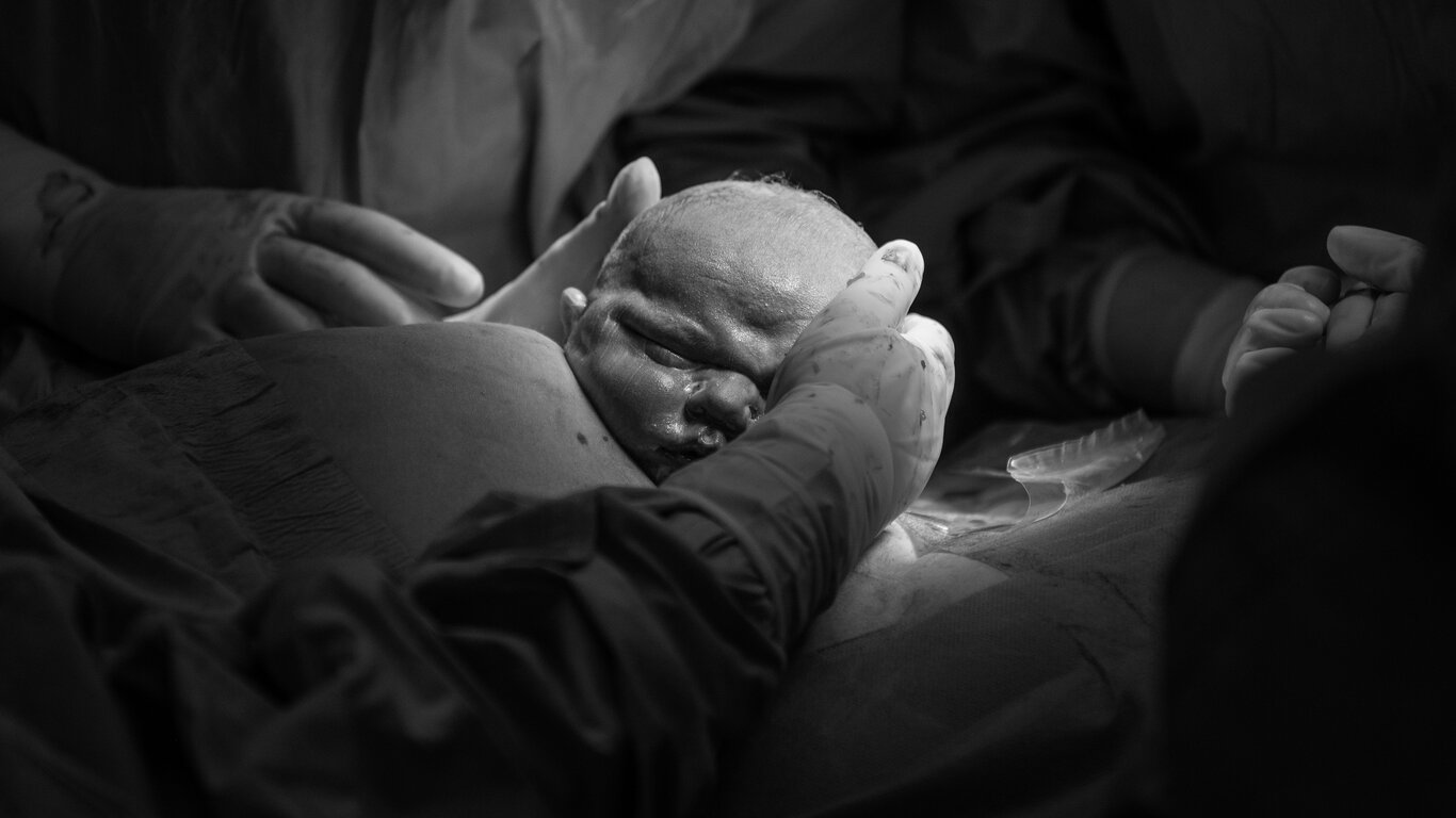 Bildet viser MAC-keisersnitt