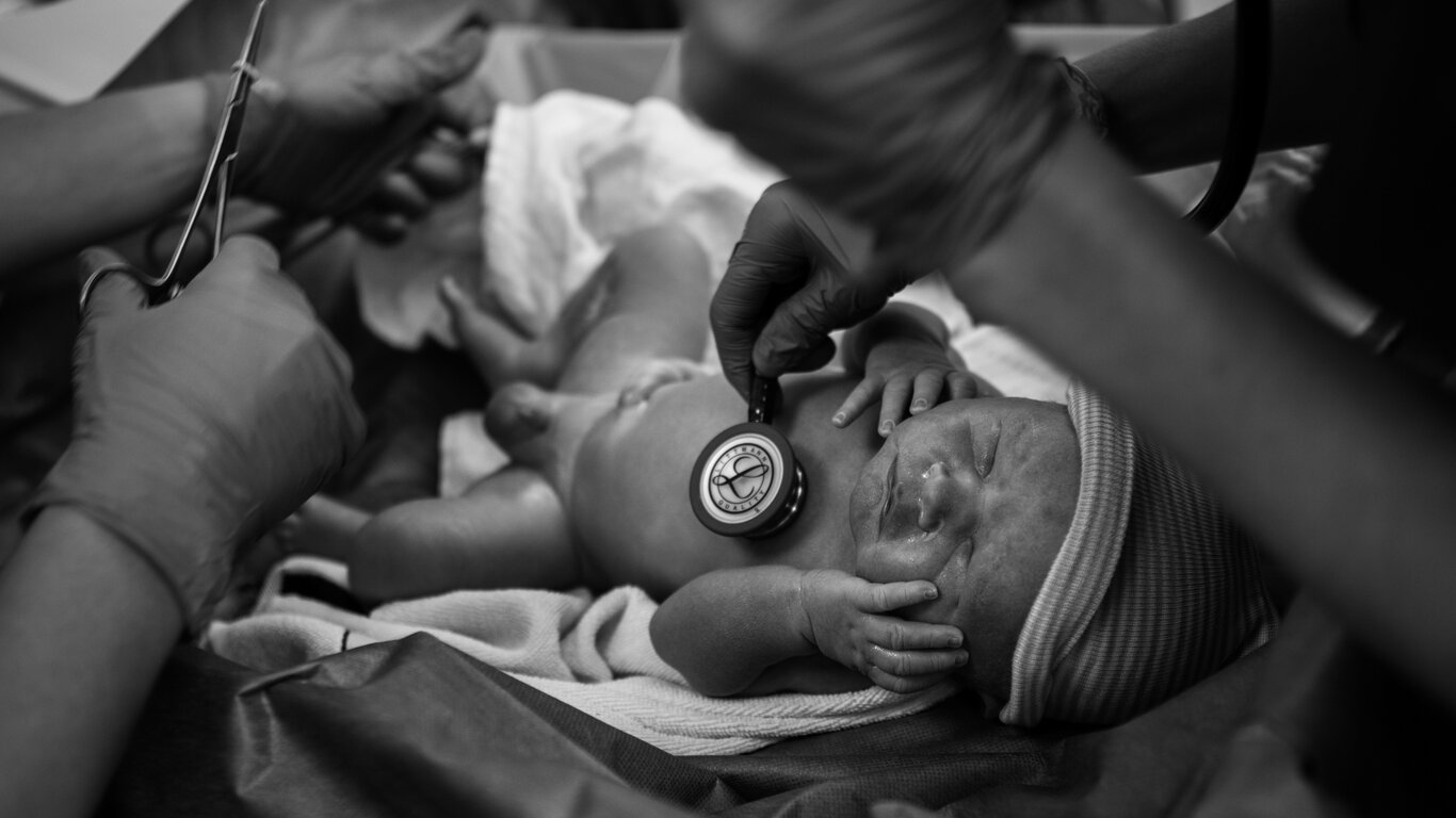 Bildet viser MAC-keisersnitt