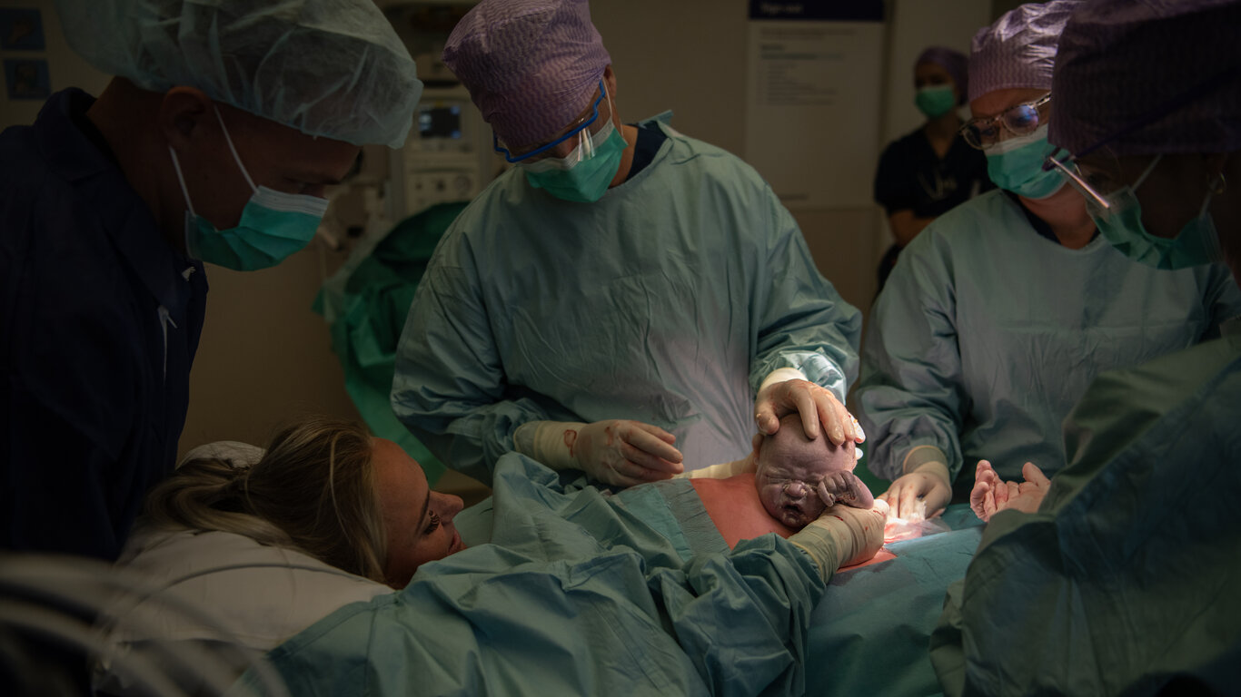 Bildet viser MAC-keisersnitt