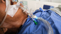 Bildet viser en respiratorpasient med en endotrakealtube via munn.