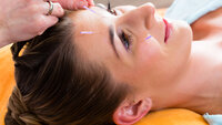 Dame som får akupunktur Dame som får akupunktur