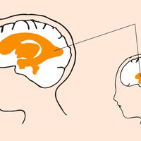 VANNHODE: Hydrocephalus (vannhode) er en tilstand med økt hjernevæske og utvidelse av hjernens naturlige hulrom, ventrikkelsystemet. Kilde: Oslo-universitetssykehus. Illustrasjon: Monica Hilsen