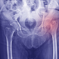 Bildet vier et røntgenbilde av bekkenet.