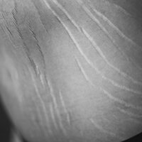 Bildet viser deler av en naken kropp med strekkmerker