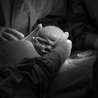 Bildet viser MAC-keisersnitt